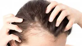 این میوه موجب رویش موهای ریخته می شود