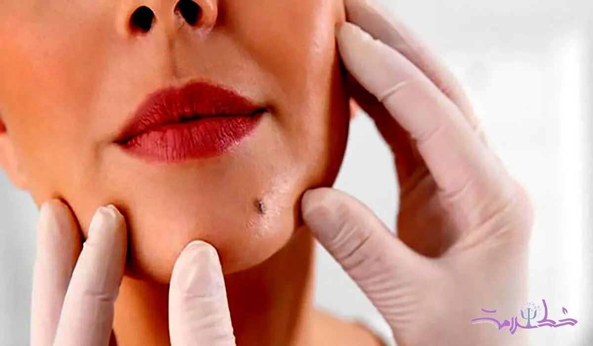 تشخیص خال‌ های خطرناک و مادرزادی