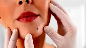 تشخیص خال‌ های خطرناک و مادرزادی