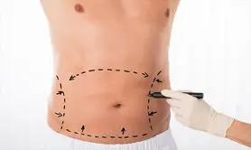آبدومینوپلاستی چیست؟ / چه کسانی می توانند این عمل را انجام دهند؟