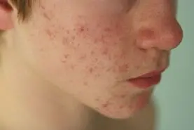اشتباهاتی که عوارض جبران‌ ناپذیری برای پوست دارند