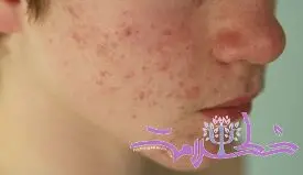 اشتباهاتی که عوارض جبران‌ ناپذیری برای پوست دارند
