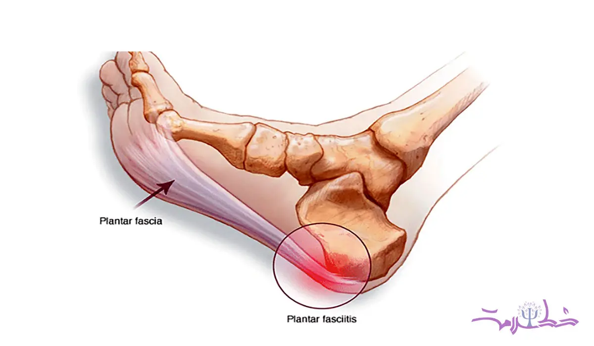 چرا فاشیای کف پا درد می گیرد و گزگز می کند؟ + و راه درمان
