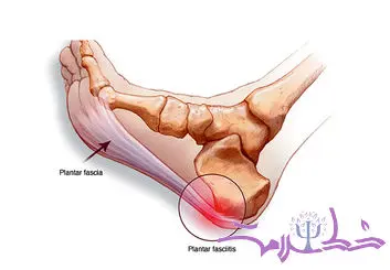 چرا فاشیای کف پا درد می گیرد و گزگز می کند؟ + و راه درمان