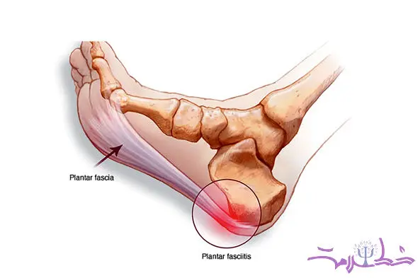 چرا فاشیای کف پا درد می گیرد و گزگز می کند؟ + و راه درمان