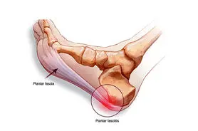 چرا فاشیای کف پا درد می گیرد و گزگز می کند؟ + و راه درمان