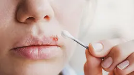 تبخال را با این دو روغن در دسترس ریشه کن کنید+ علل و راهکارها