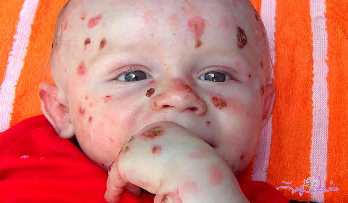 بیماری پروانه‌ای چیست؟ انواع، علائم و روش‌های درمانی