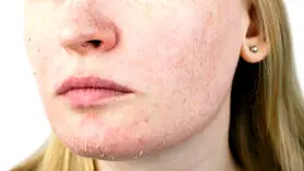 کرم طبیعی خانگی برای رفع خشکی پوست 