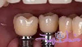 ایمپلنت تک دندان یا ایمپلنت چند دندان؛ کدام گزینه برای شما مناسب تر است؟