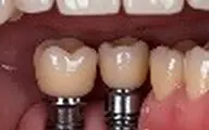 ایمپلنت تک دندان یا ایمپلنت چند دندان؛ کدام گزینه برای شما مناسب تر است؟