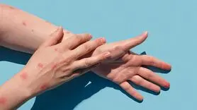 آبله میمون در ایران به وضعیت اضطراری رسیده یا نه؟