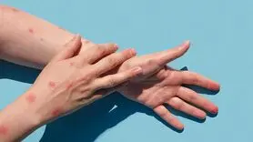 آبله میمون در ایران به وضعیت اضطراری رسیده یا نه؟