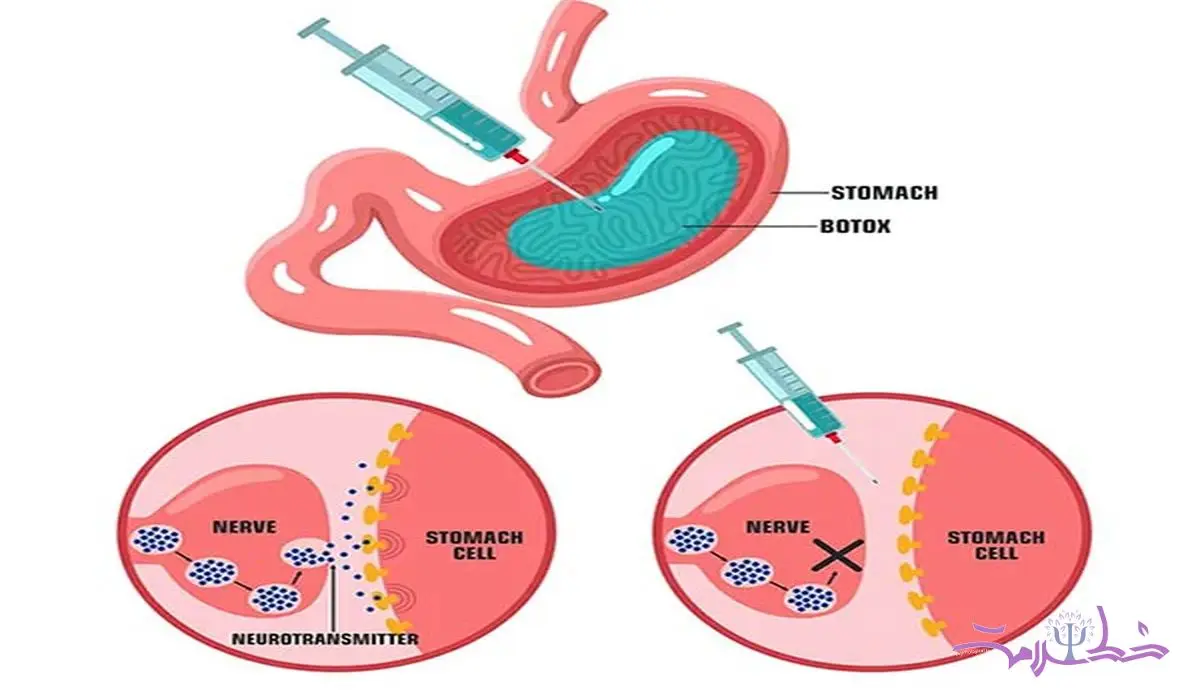 آیا همچنان بوتاکس معده در صدر روش‌های لاغری بدون جراحی است؟