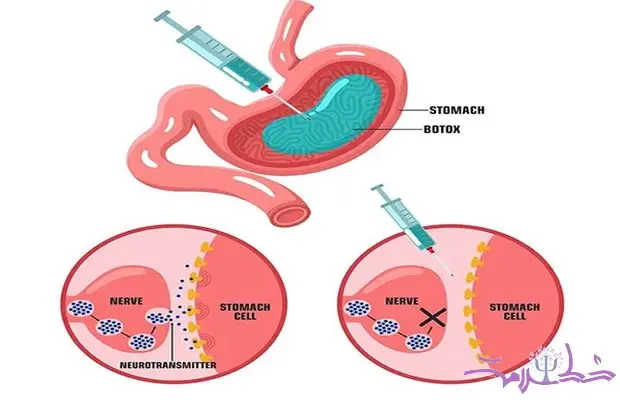 بوتاکس معده چیست؟