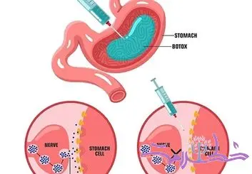آیا همچنان بوتاکس معده در صدر روش‌های لاغری بدون جراحی است؟