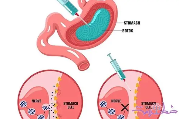 بوتاکس معده چیست؟