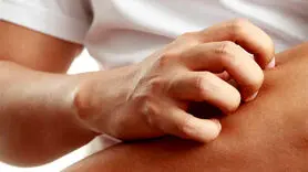 چرا پوست دست تان در آفتاب کهیر می زند؟