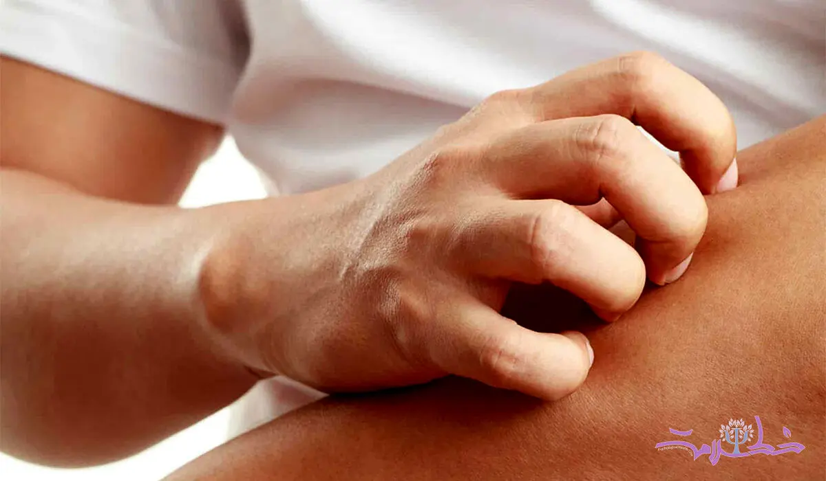 چرا پوست دست تان در آفتاب کهیر می زند؟