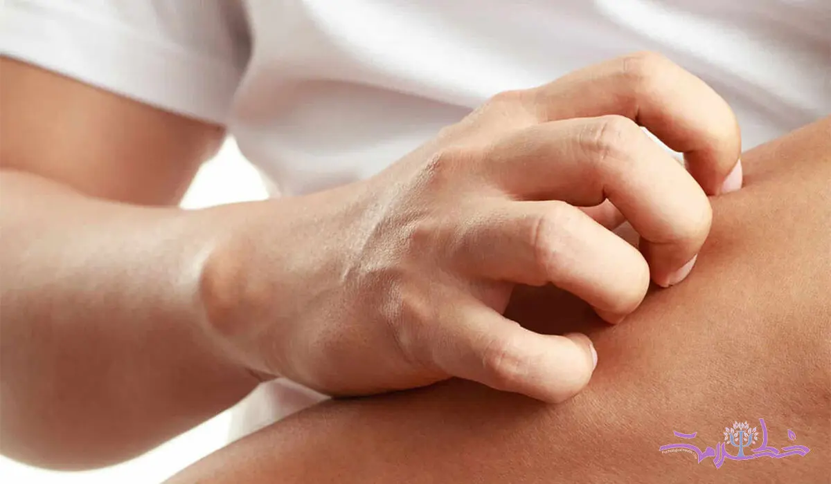 چرا پوست دست تان در آفتاب کهیر می زند؟