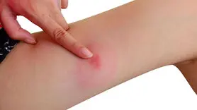 سندرم اسکیتر چیست؟/ چه افرادی به این سندرم مبتلا می شوند؟