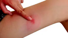 سندرم اسکیتر چیست؟/ چه افرادی به این سندرم مبتلا می شوند؟
