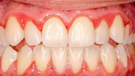 برای تقویت لثه های تان چه بخورید؟