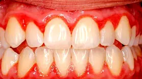 برای تقویت لثه های تان چه بخورید؟