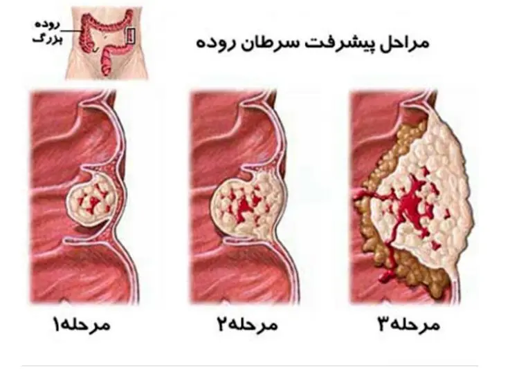 سرطان روده بزرگ؛ علت، نشانه‌ها و راه‌های درمان آن