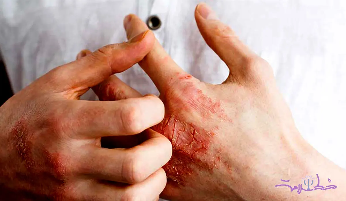 بیماری سلیاک چیست و چه علایمی دارد؟