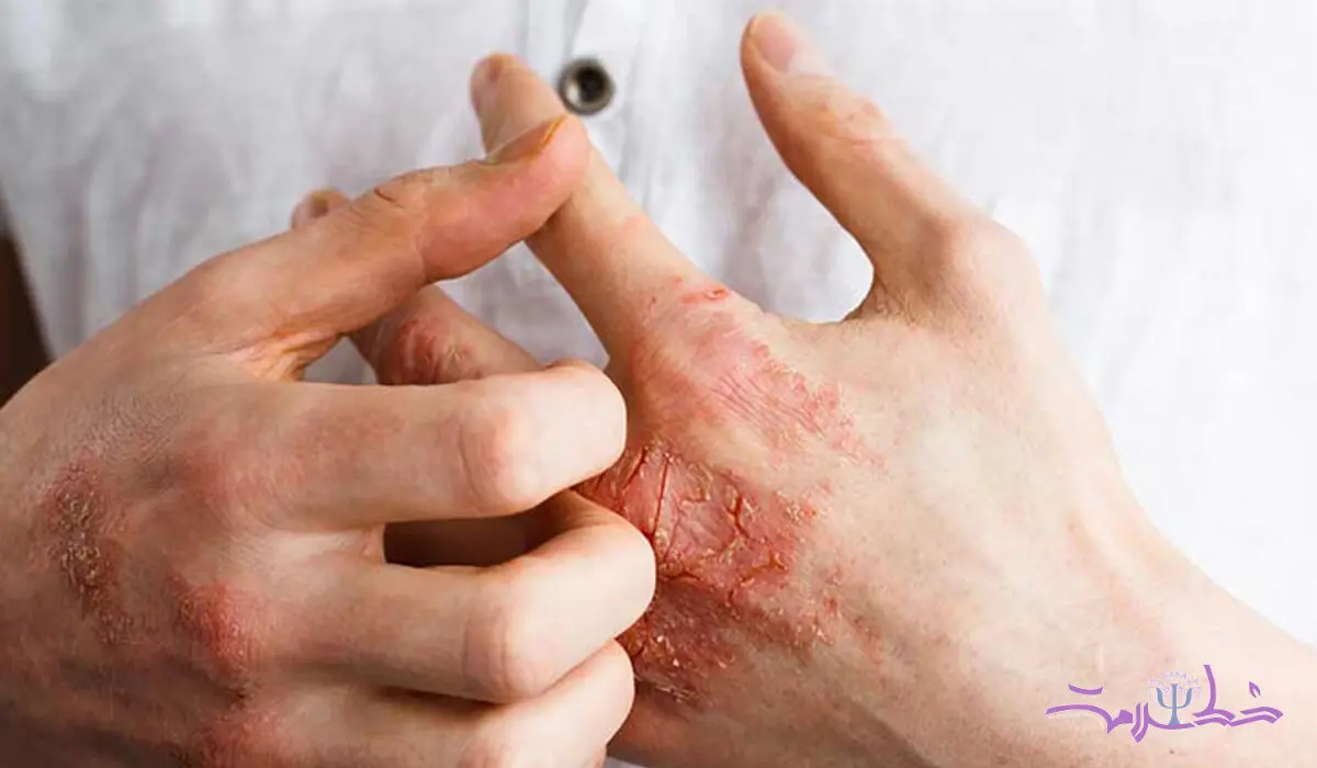 بیماری سلیاک چیست و چه علایمی دارد؟