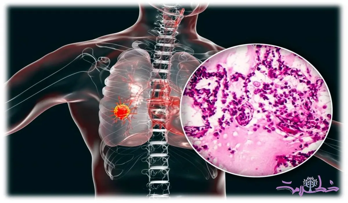 کشف یک روش ساده برای تشخیص زودهنگام سرطان ریه