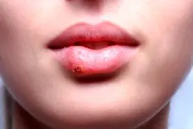 اگر تبخال دارید این مواد غذایی را حتما بخورید