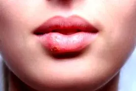 اگر تبخال دارید این مواد غذایی را حتما بخورید