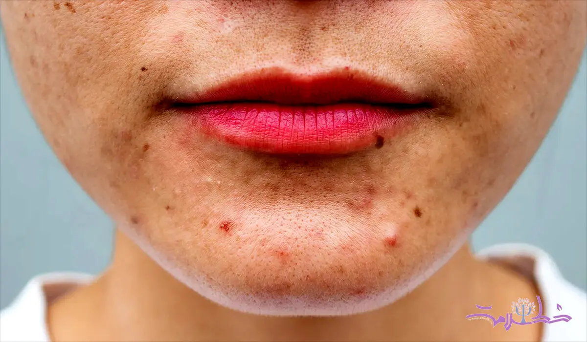 چگونه جوش های هورمونی را از جوش های ناشی از تغذیه تشخیص دهیم؟ + جدول مقایسه 