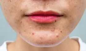 چگونه جوش های هورمونی را از جوش های ناشی از تغذیه تشخیص دهیم؟ + جدول مقایسه 
