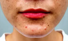 چگونه جوش های هورمونی را از جوش های ناشی از تغذیه تشخیص دهیم؟ + جدول مقایسه 