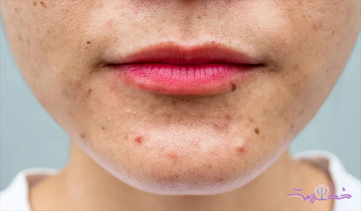 چگونه جوش های هورمونی را از جوش های ناشی از تغذیه تشخیص دهیم؟ + جدول مقایسه 