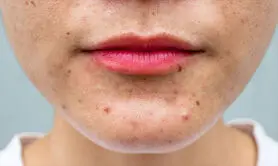 چگونه جوش های هورمونی را از جوش های ناشی از تغذیه تشخیص دهیم؟ + جدول مقایسه 