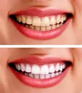 5 شگرد خانگی و طبیعی برای سفید کردن دندان ها + لبخندتان را هالیوودی کنید