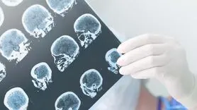رابطه هورمون درمانی با کاهش خطر ابتلا به آلزایمر