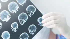 رابطه هورمون درمانی با کاهش خطر ابتلا به آلزایمر