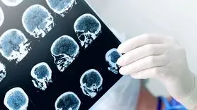 رابطه هورمون درمانی با کاهش خطر ابتلا به آلزایمر