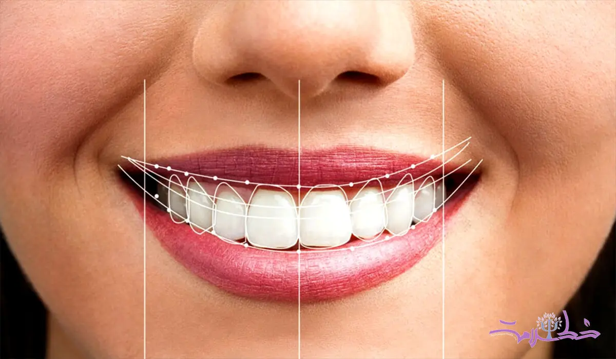 لمینت یا کامپوزیت؟ کدامیک برای دندان مناسب تر است؟