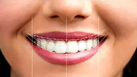 لمینت یا کامپوزیت؟ کدامیک برای دندان مناسب تر است؟