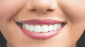 لمینت یا کامپوزیت؟ کدامیک برای دندان مناسب تر است؟