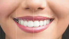 لمینت یا کامپوزیت؟ کدامیک برای دندان مناسب تر است؟
