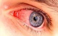 16 بیماری چشم به همراه علائم و درمان