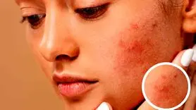 چه غذاهایی باعث التهاب پوست می شود؟ + توصیه های تغذیه ای برای پوست سالم
