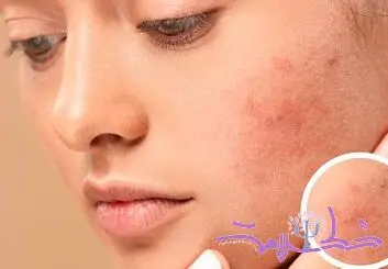 چه غذاهایی باعث التهاب پوست می شود؟ + توصیه های تغذیه ای برای پوست سالم